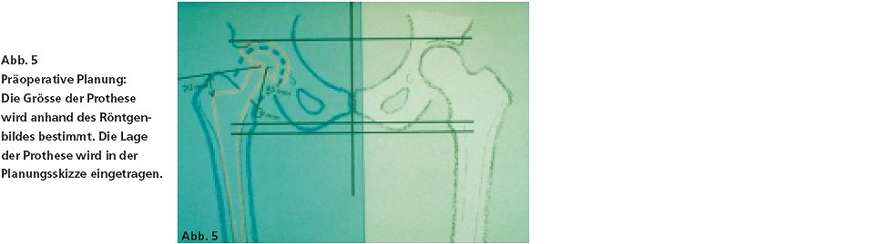 Wie wird die Operation durchgeführt? Vor der Operation berechnet der Arzt anhand des Röntgenbildes die Grösse der Prothesenkomponenten (vgl. Abb. 5).