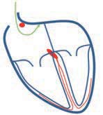 weich dünne (ca. 2 mm) isolierte Kabel, die mit einem Ende (Stecker) am Schrittmacher angeschlossen und mit dem anderen Ende (Elektrodenspitze) im rechten Herzen platziert werden.