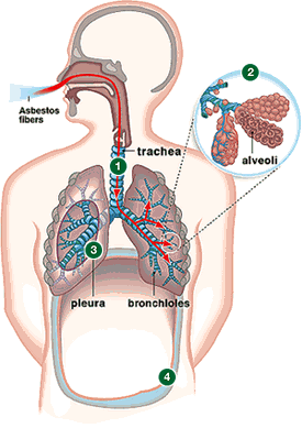Aufnahme über die Atemwege Asbest-Fasern gelangen bis in die Lungenbläschen Sie