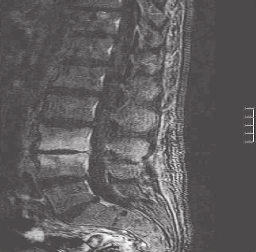 Auf einen Blick Lumbale erosive Osteochondrose versus infektiöse Spondylodiszitis: Ein Fallbericht I. Stavrou, J.