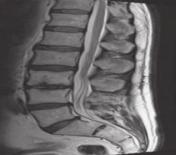 Die Follow-up-MRT 14 Monate nach dem Eingriff liefert keine Hinweise mehr für Osteochondrosezeichen (Abb. 3). Der Patient bleibt schmerzfrei.