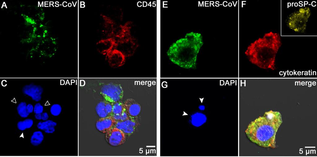 Ergebnisse Abbildung 37: Morphologische Kennzeichen der Apoptose in MERS-CoV-infizierten Zellen aus der BAL eines MERS-CoV-infizierten Patienten.