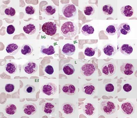 Nr. 06: Refraktäre Zytopenie mit multilineärer Dysplasie (RCMD) 10/16 Abbildung 7: RAEB-2 Leukozyten aus verschiedenen Aufnahmen ausgeschnitten; schwer atypische neutrophile Granulozyten, alle plump
