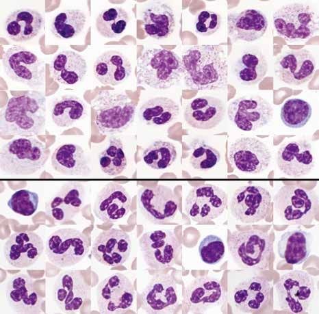 Nr. 06: Refraktäre Zytopenie mit multilineärer Dysplasie (RCMD) 13/16 Abbildung 9: Beispiel eines Virusinfekts Leukozyten aus verschiedenen Aufnahmen ausgeschnitten; oberhalb der schwarzen Linie