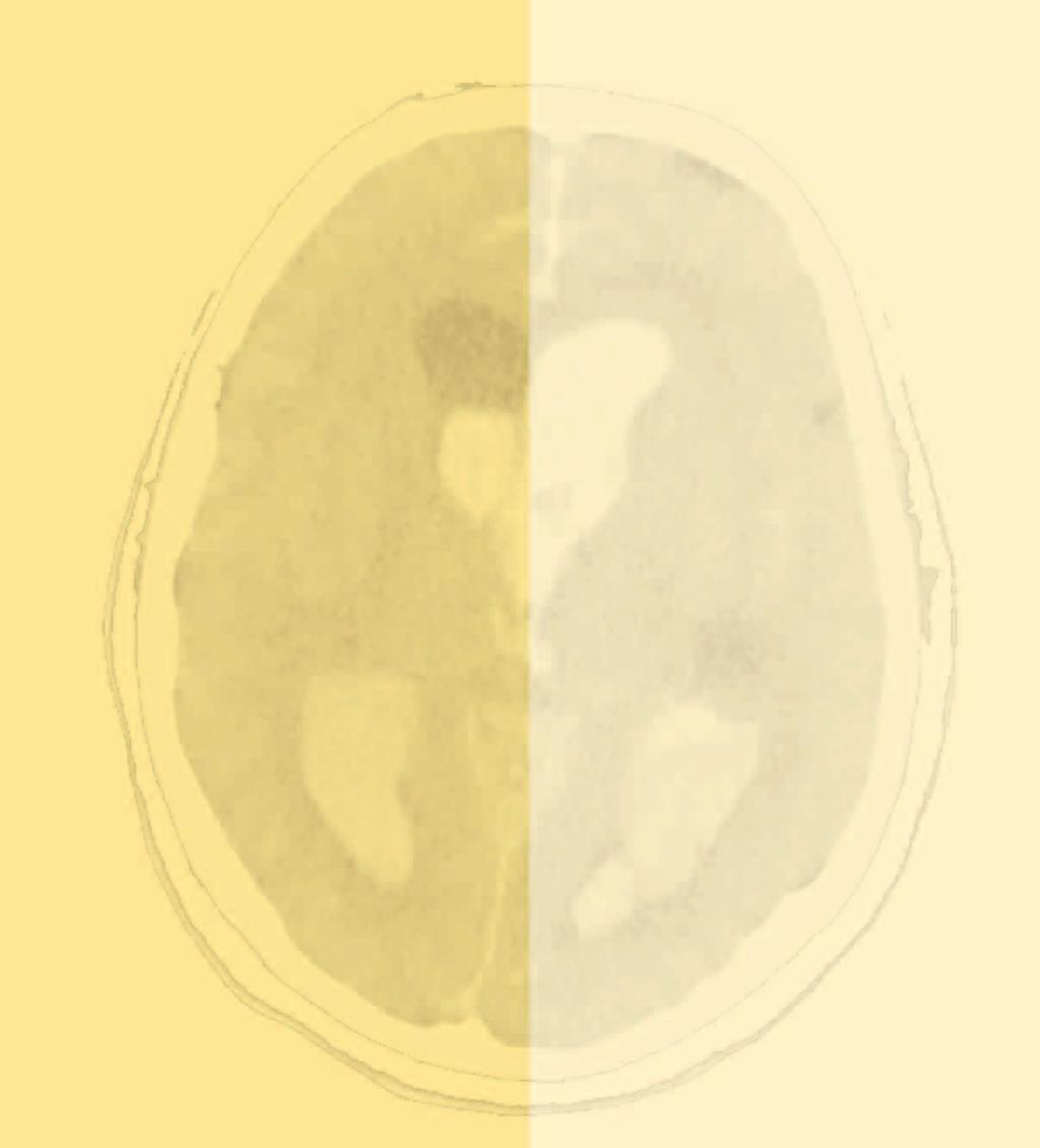 Journal für Neurologie Neurochirurgie und Psychiatrie 2013; 14 (4), 203-205 Homepage: www.kup.