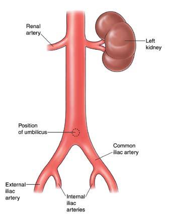 1. Was ist ein Aneurysma? Ein Aneurysma ist eine Ausdehnung einer geschwächten Arterie, die sich ähnlich wie der Schlauch in einem abgenutzten Fahrradreifen aufbläht.