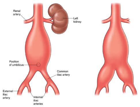 Abb. 2. Bauchaortenaneurysma (AAA) Nierenarterie Linke Niere Position des Bauchnabels Gemeinsame Hüftarterie/Darmbeinarterie (A. iliaca communis) Äußere Hüftarterie (A.