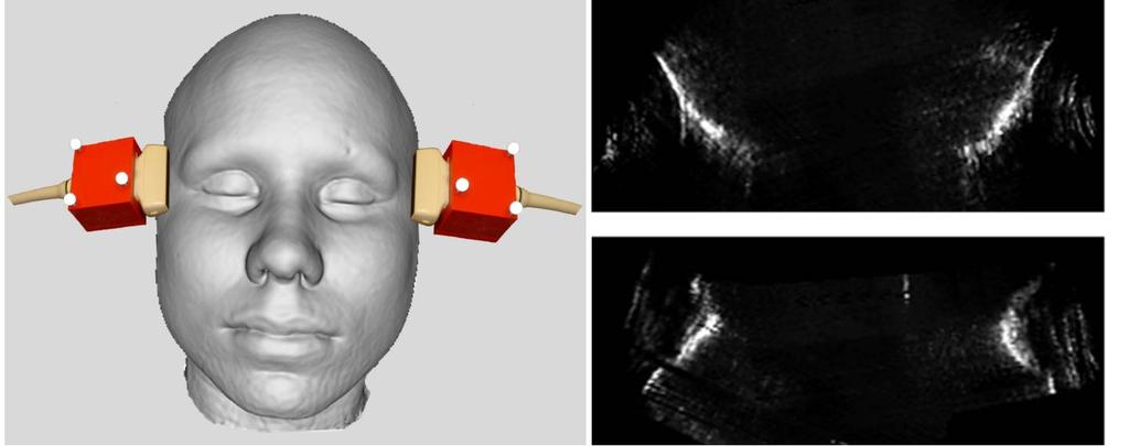 2: Ultraschall-Scanpfad Femur: Die Ultraschallaufnahme startet am Femurschaft und reicht bis zur Facies patellaris 3: Ultraschall-Scanpfad Kopf; Links: Ultraschallaufnahme beider Schläfen; rechts
