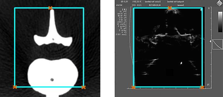 40 3 Methoden Abb. 3.6: Vorregistrierung mittels 2D-Ultraschallschichtbildes: Links: Maske eines linearen Ultraschallwandlers, eingezeichnet in einem axialen CT-Schichtbild eines LWS- Knochenmodells;