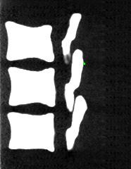 58 4 Das ultraschallbasierte Navigationssystem A B C Abb. 4.3: Anzeige der Pointerspitze in CT-Schichtbildern eines LWS-Knochenmodells; A: sagittales Schichtbild, B: coronales Schichtbild, C: axiales