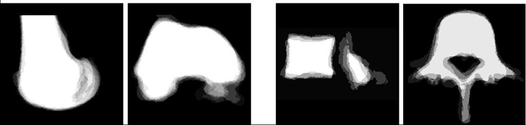 4: Femur- und LWS-Volumen nach dem Alignment; links: sagittale und axiale Schichtbilder des zueinander ausgerichteten Femur-Volumen; rechts: sagittale und axiale Schichtbilder des zueinander