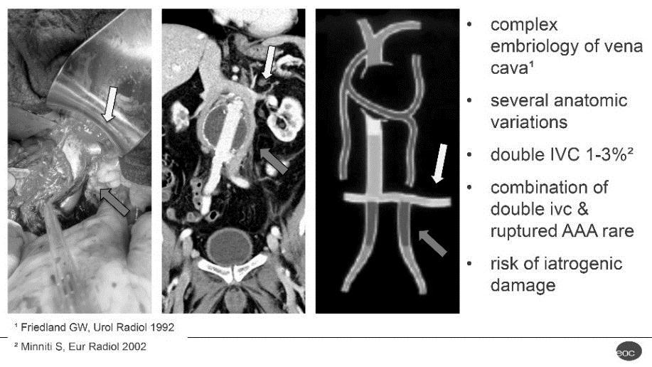 Vascular anatomic variation does add further challenges to the intricacy of the procedure.