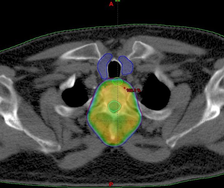 4 Der Arzt kann sich in jedem CT-Schnitt die Dosisverteilung anschauen und mit Hilfe sog. Dosis-Volumen-Histogramme die Strahlenbelastung in jeder eingezeichneten Struktur beurteilen.