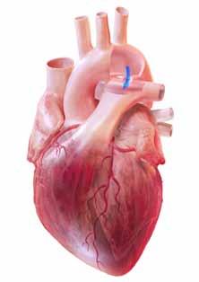 Aorta Lungenarterie Abbildung 2 Herz mit einem offenen Ductus arteriosus Vorhof gepumpt.