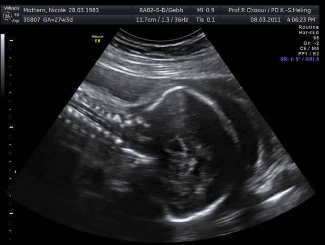 Chiari II Malformation Verschiebung