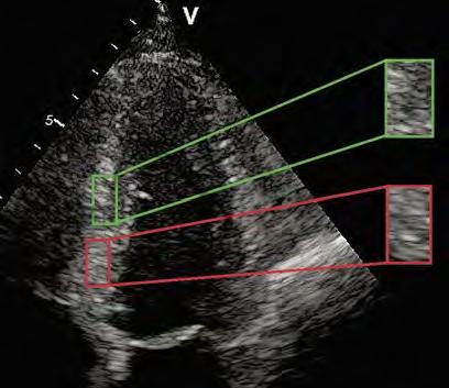 reduced function. However, standard echocardiography does not necessarily detect very early stages. Fortunately, ultrasound techniques underwent tremendous improvements throughout the last years.