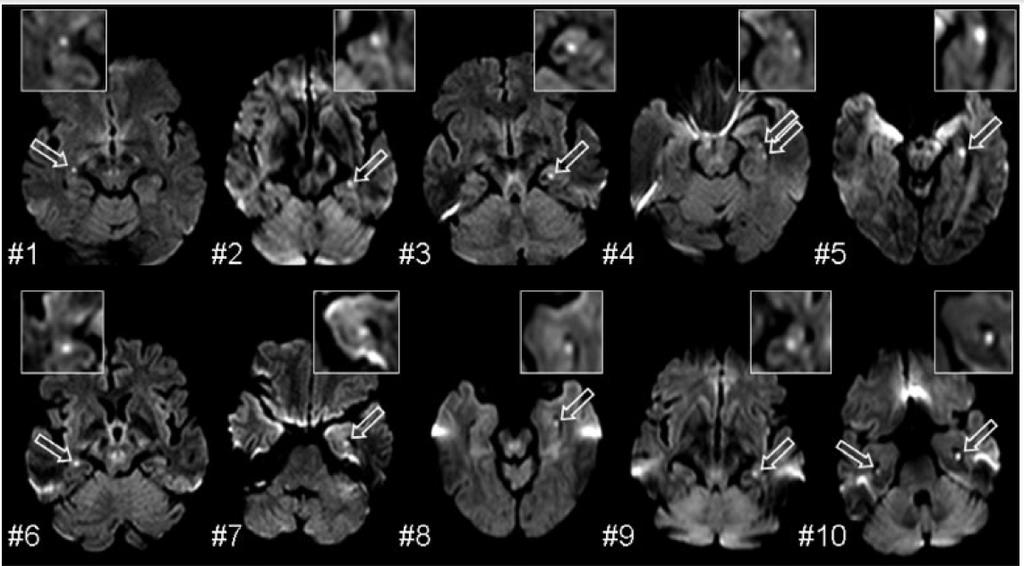 Transient Global Amnesia: Diffusion-Weighted Imaging Lesions and Cerebrovascular Disease Enzinger et al (Stroke. 2008;39:2219-2225.