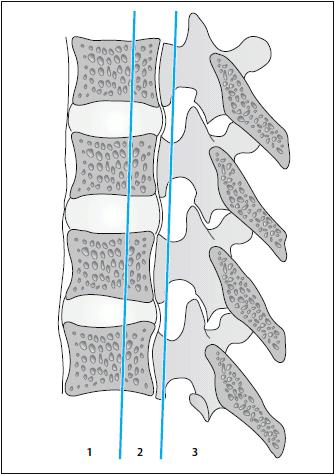 Material und Methoden Abbildung 6: Drei-Säulen-Modell nach Denis 35 Eine Hyperflexion kann zu einer isolierten hinteren Säulenverletzung führen, wohingegen die vordere Säule vor allem bei
