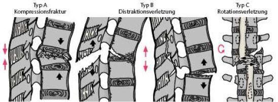 Material und Methoden Einordnung auch heute noch pathomorphologische und prognostische Gesichtspunkte ebenso berücksichtigt wie die Art des Unfallgeschehens.