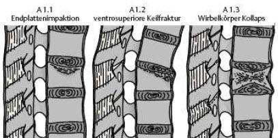 Material und Methoden innerhalb dieser hierarchisch aufgebauten Klassifikation von Typ A nach C und von eins nach drei zu.