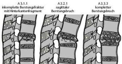 Material und Methoden Bei Berstungsfrakturen wird der Wirbelkörper entweder komplett oder inkomplett zerstört. Dabei ist die Hinterkante ebenfalls betroffen (siehe Anhang 1).