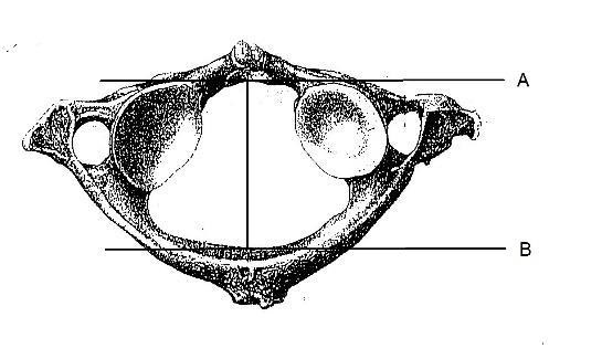 Außerdem wurde die anterior-posterior Distanz des Wirbelbogens sowohl für den inneren Rand des Arcus vertebrae als auch für den äußeren Rand mit dem Gleitzirkel gemessen.