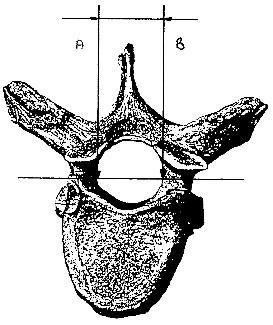 Material und Methoden Analog dazu wurde der transversale Durchmesser des Foramen vertebrale, also die geradliniger Entfernung zwischen den medialen Punkten der Wurzeln der Wirbelbögen, bestimmt.