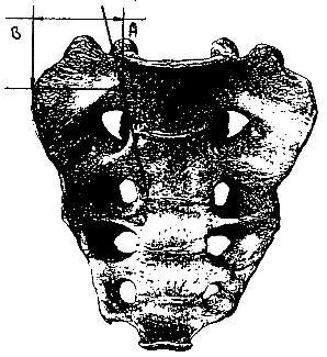 Material und Methoden Die Länge der Kreuzbeinflügel beschreibt die geradlinige Entfernung eines Punktes, der in der Mitte einer den Seitenrand der Basis ossis sacri und den Innenrand des ersten