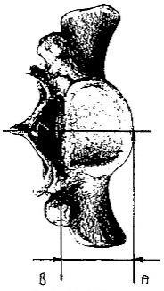 Abbildung 52: Messpunkte der Breite der oberen Öffnung des Canalis sacralis In dem Bild sind die Messpunkte für den Gleitzirkel, welche in die kraniale Ansicht des Kreuzbeins eingefügt wurden, zu