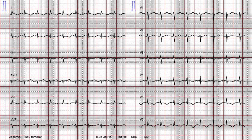 Abb.2: 12 Ableitungs-Ruhe EKG: tachykarder Sinusrhythmus, 112/min, Linkslagetyp, T-Negativierung anterolateral und inferior, verlängerte QT-Zeit mit QTc 487 ms Erweiterte Diagnostik ((Ü3))