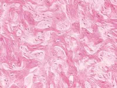 16 Abbildung 4: Myocyte disarray: keine einheitliche Zugrichtung aller Zellen bei einer humanen Biopsie bei hypertropher Kardiomyopathie (nach Maron [34]) Ein weiteres Merkmal ist die kardiale