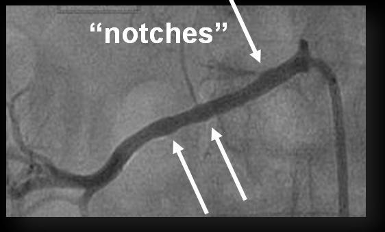 3. Methodik Abbildung 16: Angiografische Darstellung von notches Einkerbungen ( notches ), die akut nach der Abgabe des Radiofrequenzstroms entstehen können Quelle: eigene Nach Beendigung der