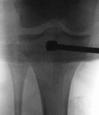 Genehmigung der British Editorial Society of Bone and Joint Surgery) gewährleistet dem Operateur ein entsprechend geringes Weichteiltrauma.