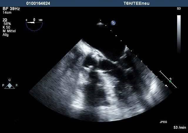 Die Abbildung 3 zeigt eine paraprothetische Abszesshöhle, die erst mit der transösophagealen Echokardiographie diagnostiziert wurde. LA RV LV Abb. 3 Prothesenendokarditis.