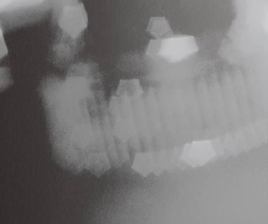 damped, to the manometer. The rising cuff pressure is indicated with no pointer overshoot thus ensuring care of the mechanism.