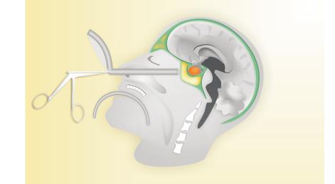 Gehirn Sehnervenkreuzung Sella Hypophyse Hypophysentumor Keilbeinhöhle Nasenhöhle Abb. 4: Schematische Darstellung der transphenoidalen Operation. und dieser entfernt.