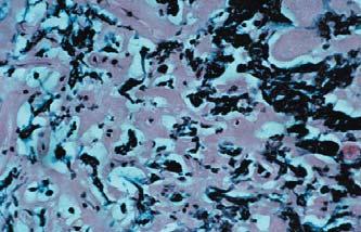 Abbildung 3: Gering granuliertes Prolaktin-Zelladenom nach Dopamin-Agonisten-Behandlung: kleine geschrumpfte Zellen mit schmalem verdichtetem Zytoplasma und reichlichen interstitiellen