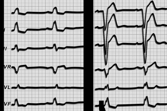 14) und Rechtsschenkelblock (Abb. 15) sind im EKG zu unterscheiden.