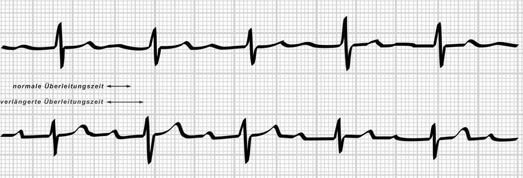 Herzschlag wird mit normaler Zeitdauer von den Vorkammern in die Kammern übergeleitet (Dauer zwischen P-Welle und QRS-Komplex), beim nächsten Schlag verlängert sich diese Überleitungszeit,