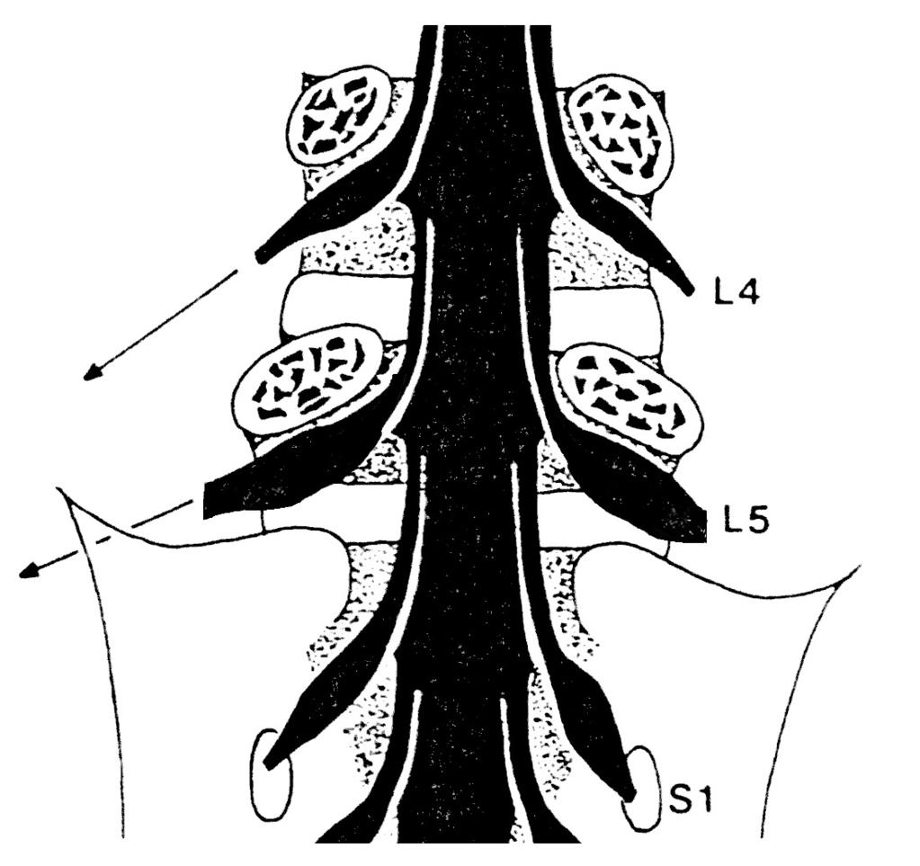 9 tender Spinalnerven bis hin zum Cauda-Syndrom resultieren.