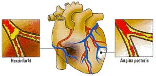 Wie entsteht eine koronare Herzkrankheit? Durch Ablagerungen von Kalk, Fett oder einem Blutgerinnsel kann es zu einer Gefäßverengung oder zu einem vollständigen Gefäßverschluß kommen.