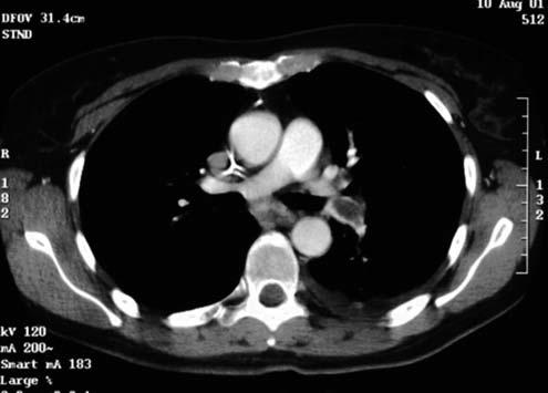Das konventionelle Thoraxbild zeigt einen linksseitigen Pleuraerguss und das CT zentrale Lungenembolien ten diese Co-Morbiditäten häufiger auf.