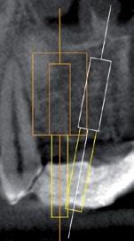 4.1.2 Kollision der Bohrhülsen Bei dieser Implantatplanung kollidieren die Bohrhülsen der beiden Implantate. Die Visualisierung des Bohrkanals macht dies deutlich sichtbar.