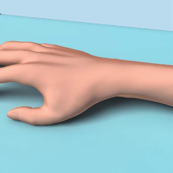 Zugang und Reposition 1 Zugang Eine standardmässige dorsale Längsinzision über dem Handgelenk anlegen.