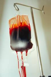 Transfusion / Austauschtransfusion SS ist keine Indikation für Routine Transfusionen Transfusions / ATT Programmen fortführen