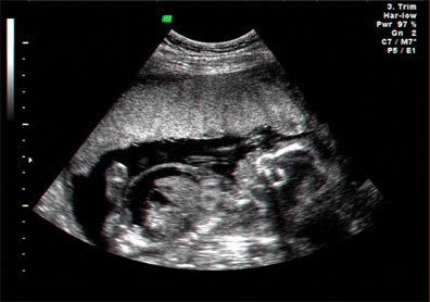 Mütterliches und fetales Monitoring Regelmäßige Ultraschalluntersuchungen Hb, Urin und RR Messung bei jedem Besuch