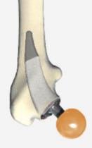 Der Erhalt der Knochensubstanz bietet deshalb wichtige Rückzugsmöglichkeiten, sollte die Endoprothese nach Jahren verschleißen und in einer so genannten