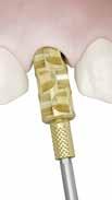 Das Design der Abdruckpfosten erfasst alle erforderlichen Informationen des Implantatanschlusses, unabhängig von der Abutment-Lösung.
