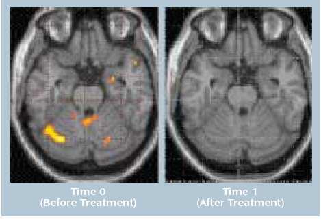 Aktivierung der Amygdala und des Kleinhirns vor und nach Behandlung 10 abstinente alkoholabhängige Patienten während olfaktorischer Stimulation mit