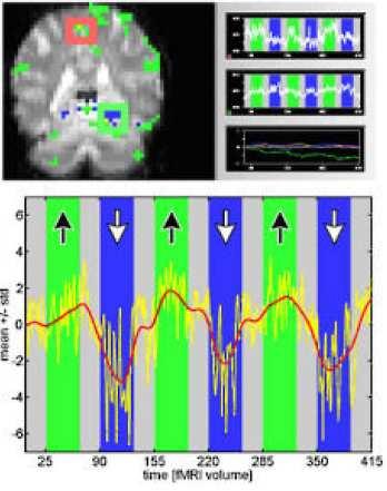 Biofeedback der Amygdala Aktivierung von Amygdala und PFC bei emotionalen Bildern